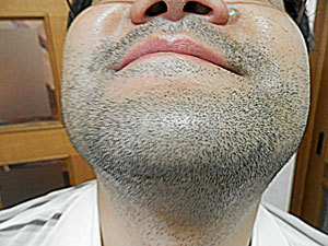 ソイエでヒゲ脱毛の効果はいかに 男の毛の悩みを解決するブログ